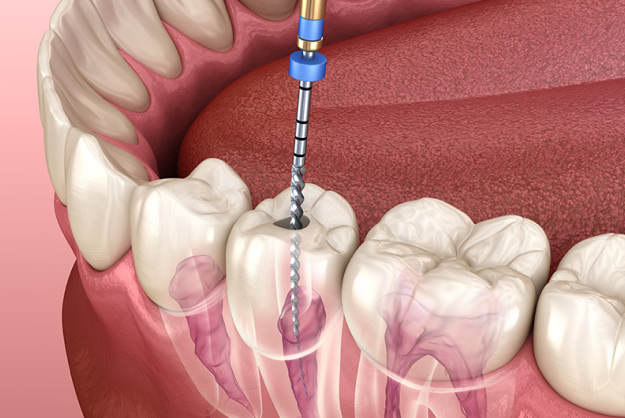 endodontics
