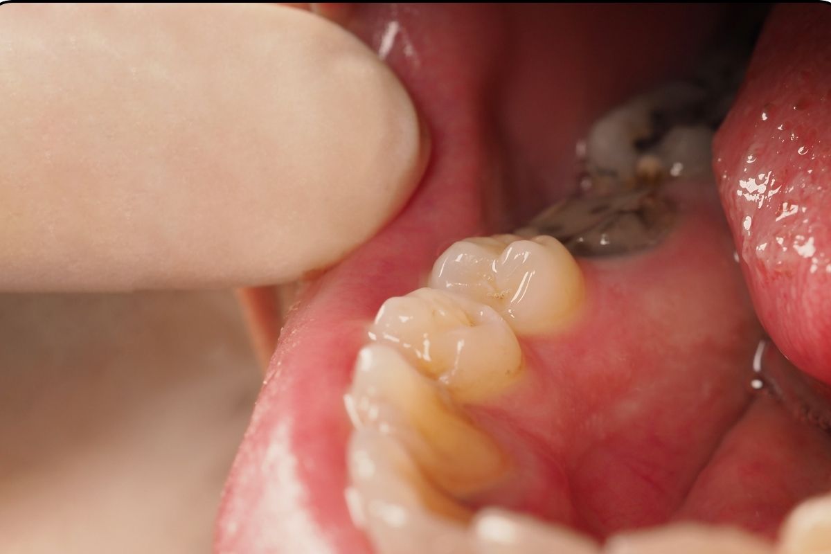 Cavities to Tooth Decay: How Sugar Affects Teeth