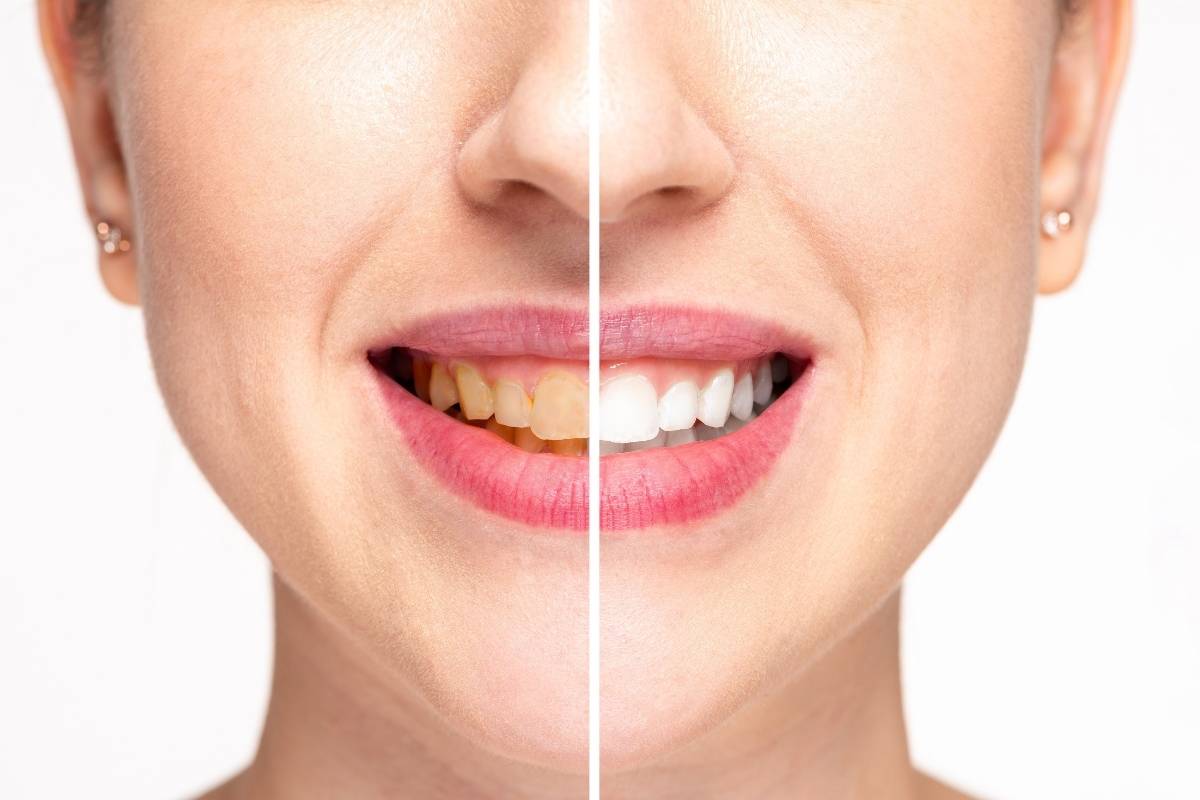 DIY Teeth Whitening in Little Rock