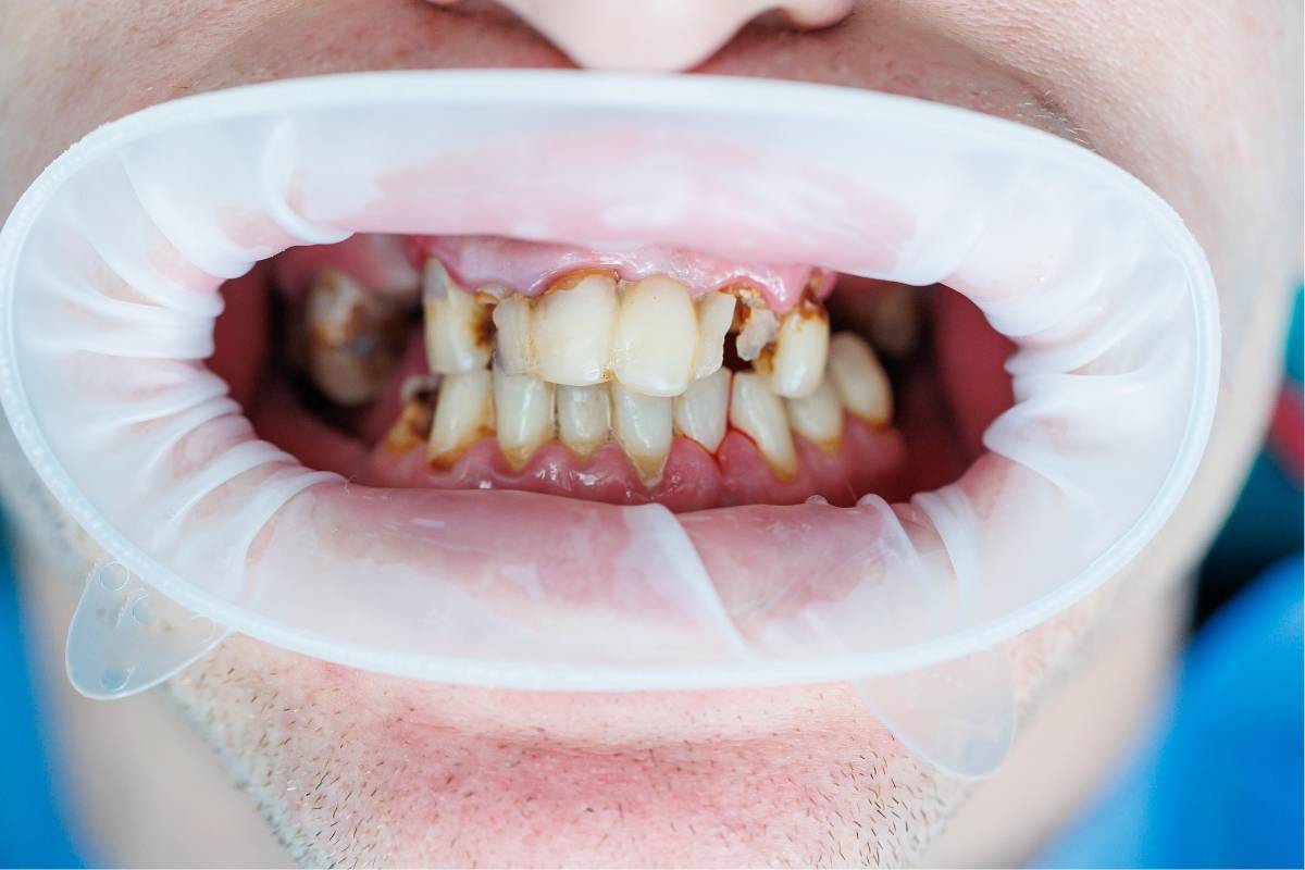 best treatment for uneven teeth and discoloration