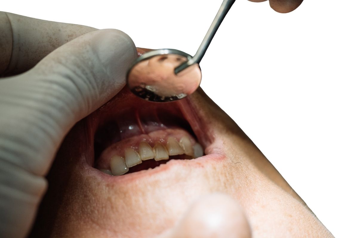 Early Signs of Tooth Decay Most People Ignore