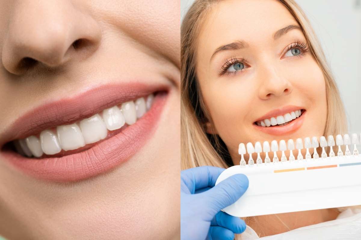 dental veneers vs teeth whitening