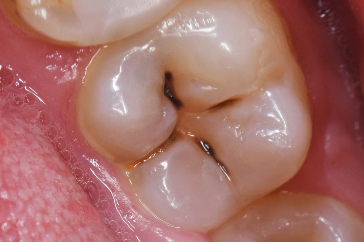 Cavities