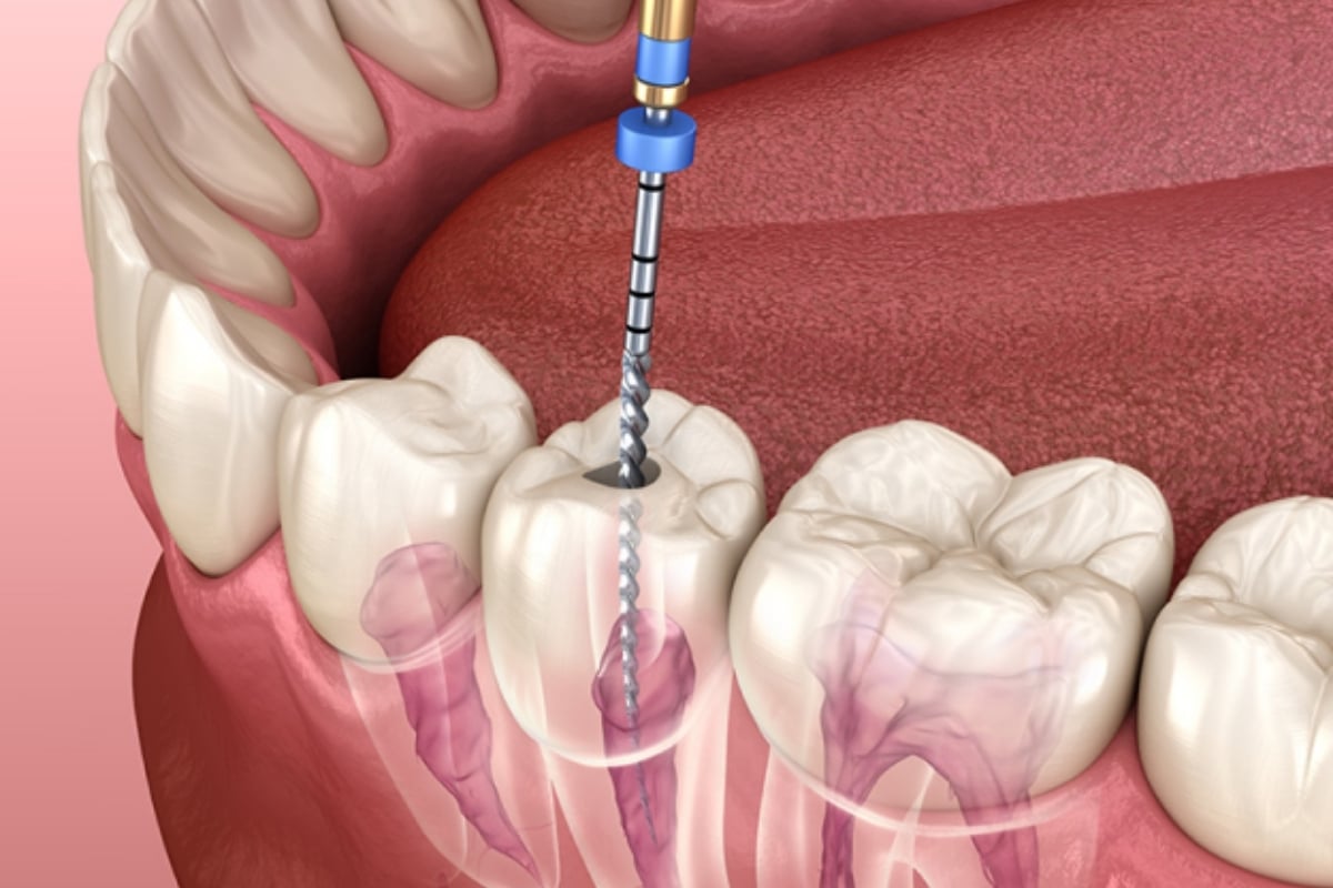Endodontist in Little Rock