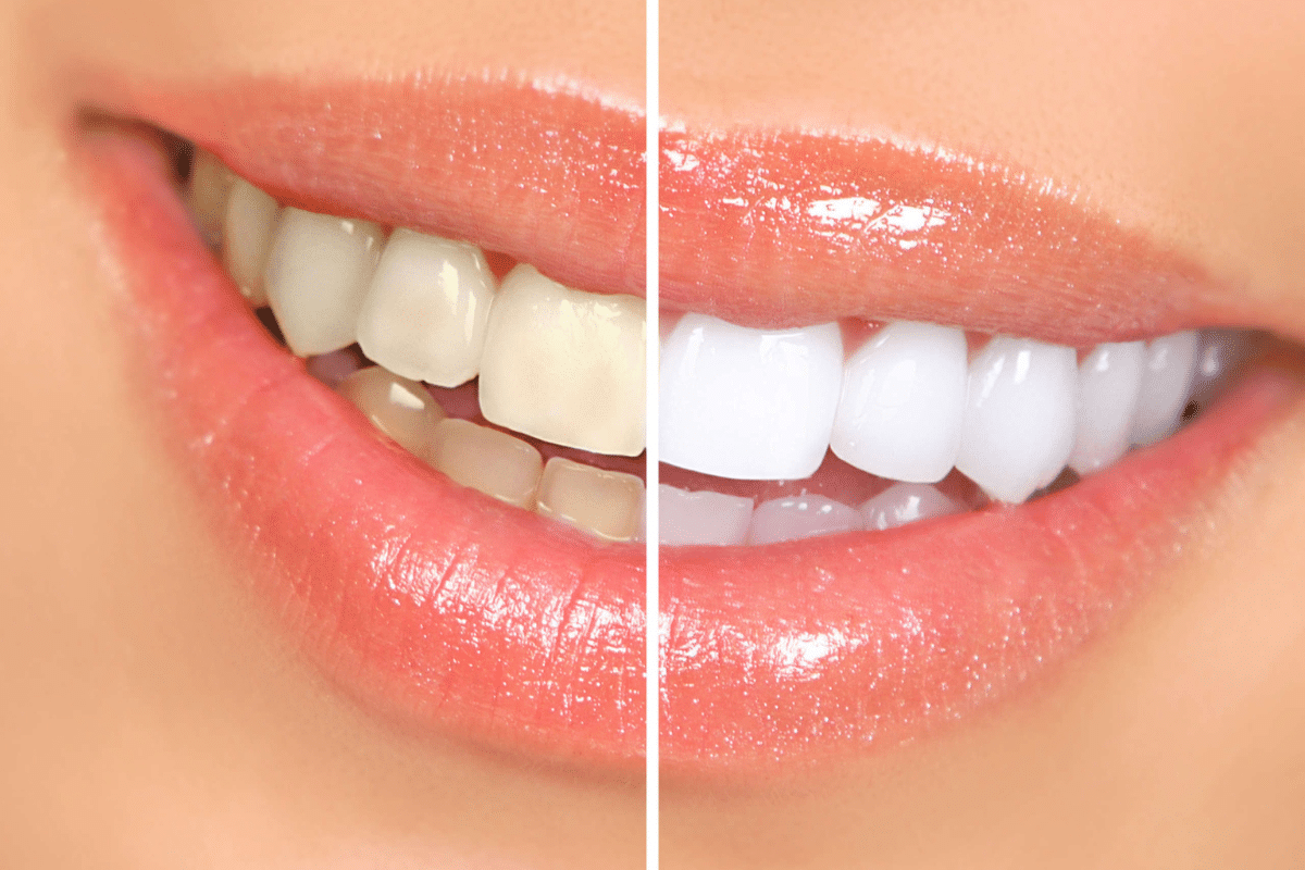 Teeth Whitening in Little Rock